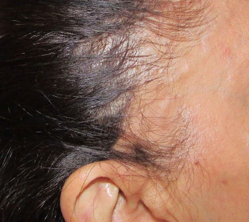 hair loss in women -- alopecia areata